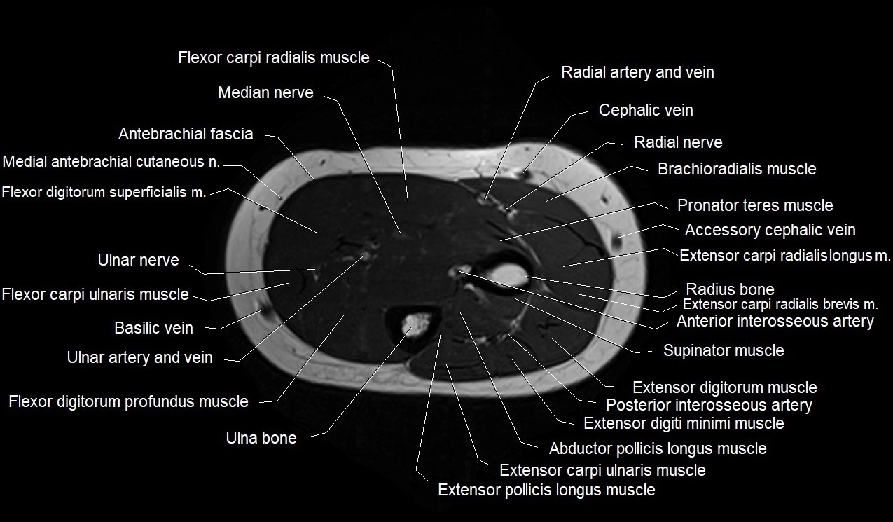 MRI 3T forearm axial cross sectional anatomy image 21.webp